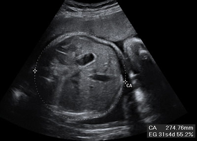 Ecografía de la medición del perímetro del abdomen fetal