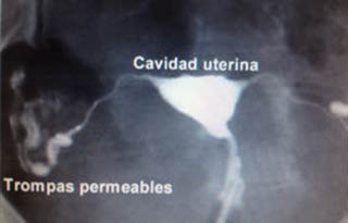 histerosalpingografía
