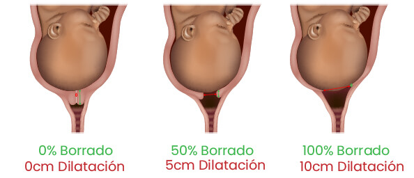 parto provocado o inducido