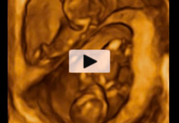 Ecografia 4D gemelos de 12 semanas